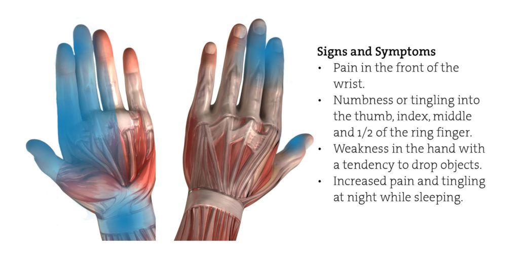 carpal tunnel syndrome arise family chiropractic